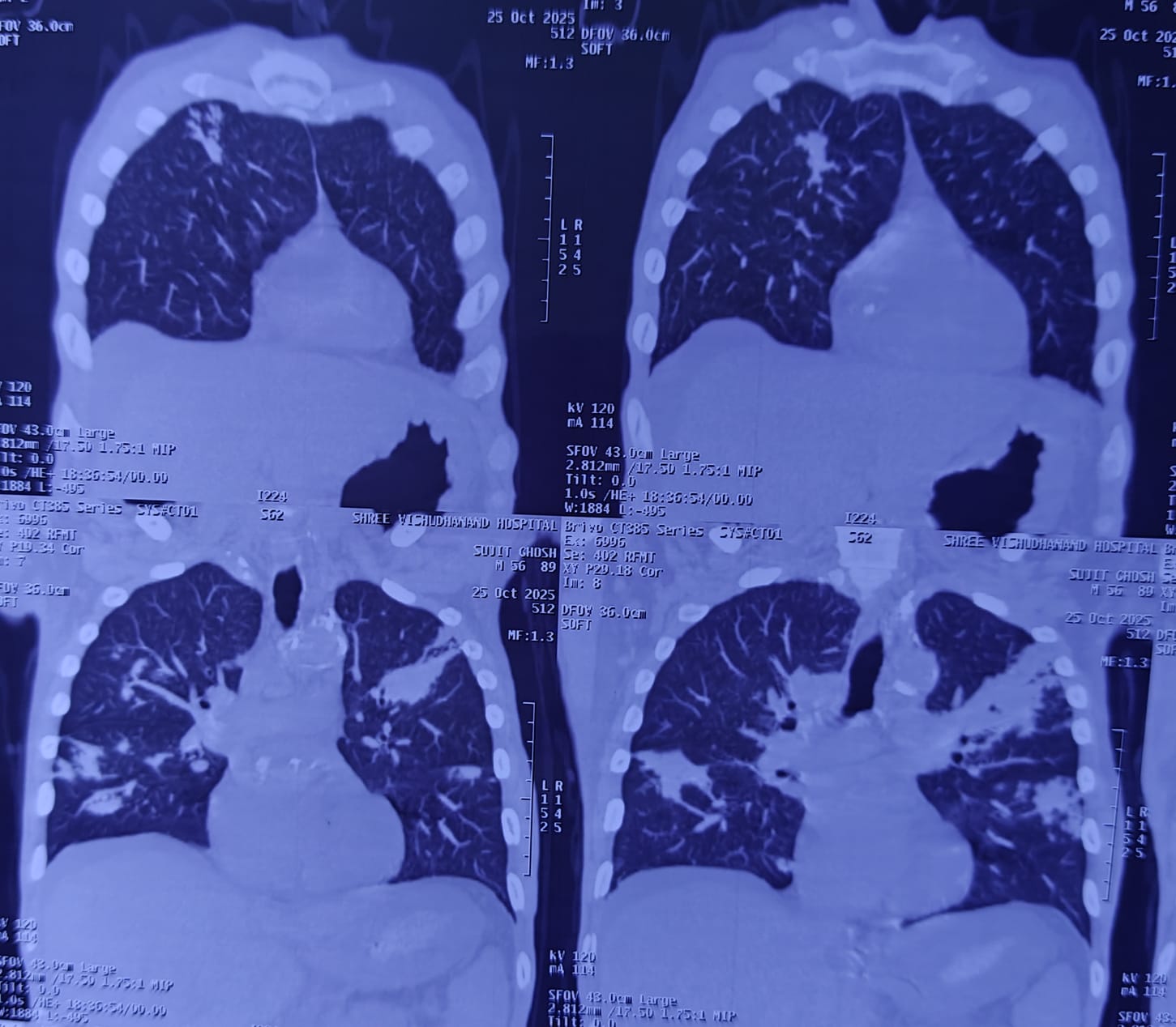 TB and HIV Recovery Story